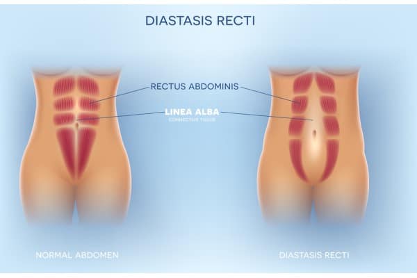 What Non-Surgical Options Are Available for Diastasis Recti Busby?