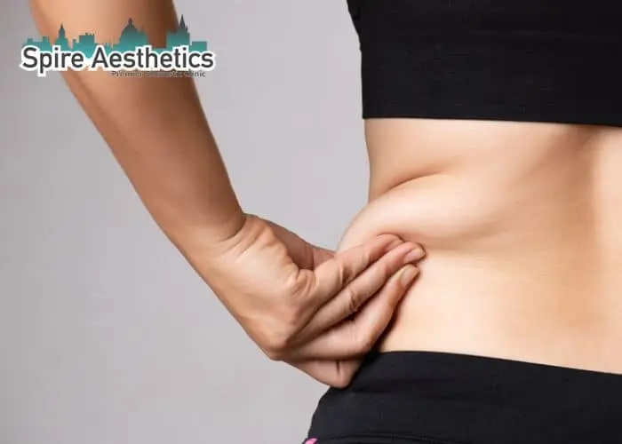 Image of woman pinching fat on their hips Busby. Fat Freezing treatment 