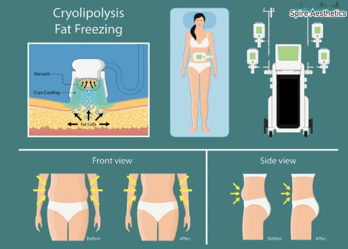 Image of diet and fat freezing combined for best results for Spire Aesthetics Busby