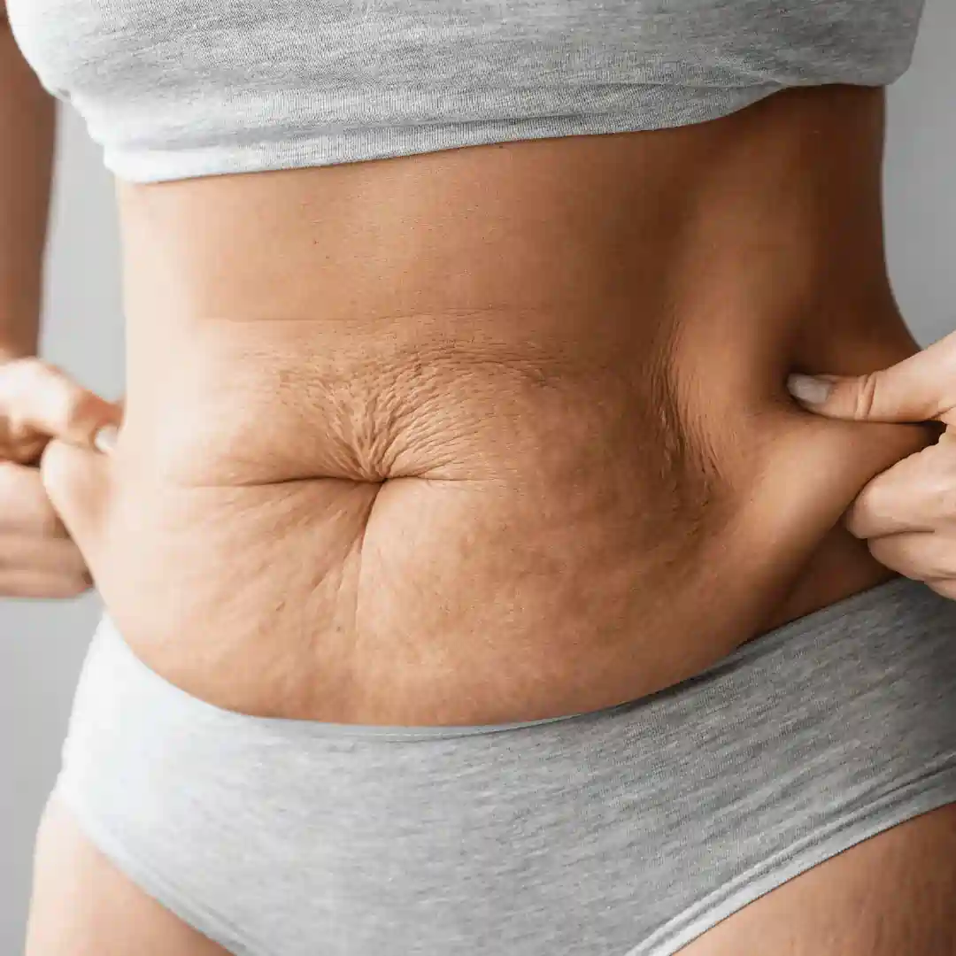 Is It Normal to Have Loose Skin After Pregnancy Busby?