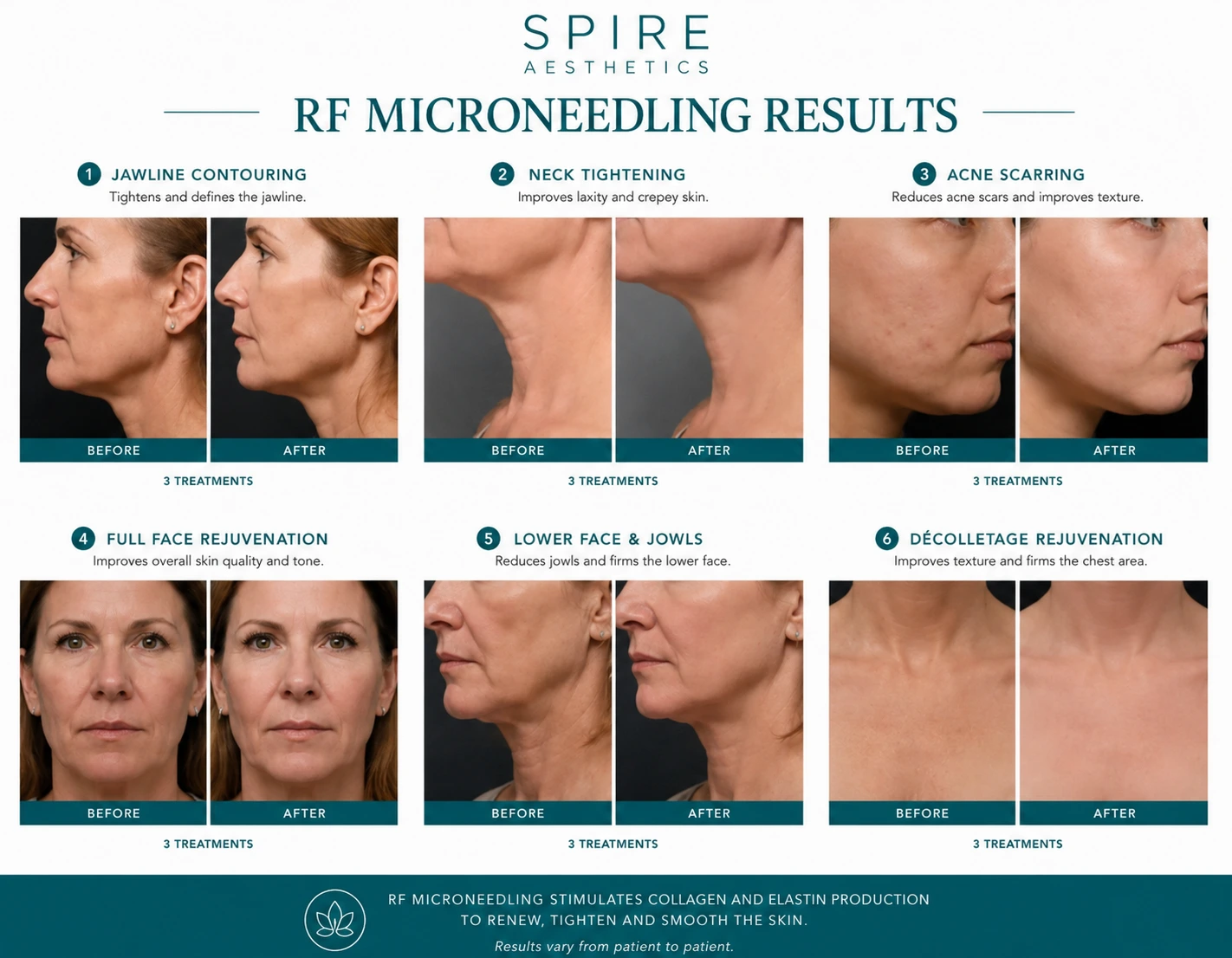 RF Microneedling Skin tightening Busby results