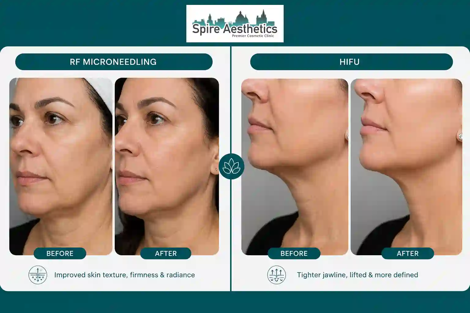Can RF Microneedling and HIFU Be Combined Busby?