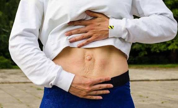 When Could Diastasis Recti Be the Missing Piece of the Puzzle Busby?