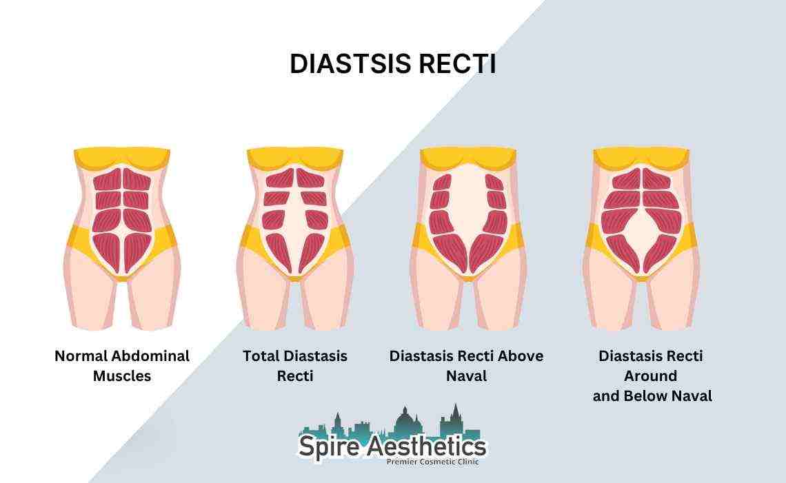 Is Non-Surgical Diastasis Recti Treatment Right for You? Common Concerns Answered Busby